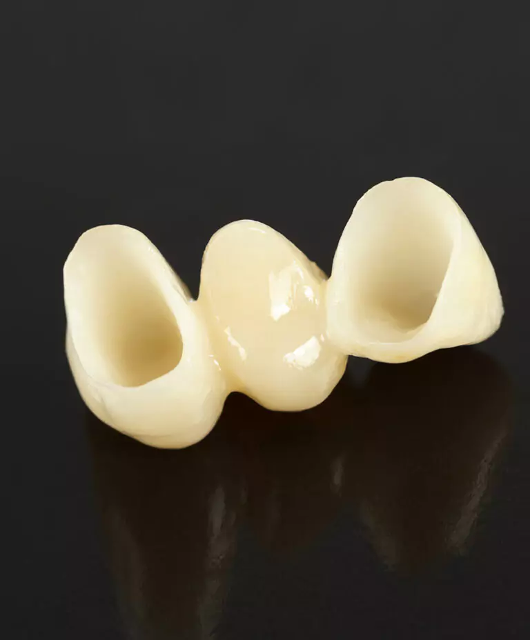 Close-up of a dental bridge designed to replace missing teeth.