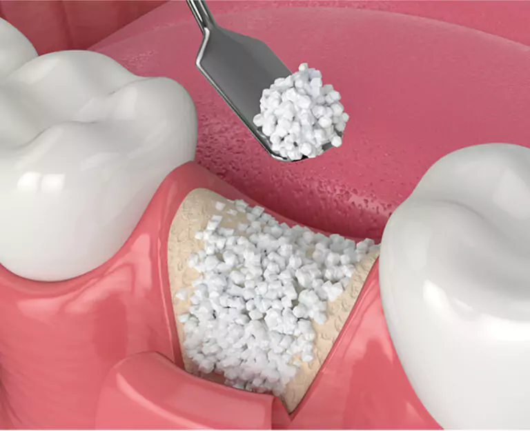 A 3D-rendered illustration of a dental bone grafting procedure, showing synthetic bone granules being placed in a tooth socket.
