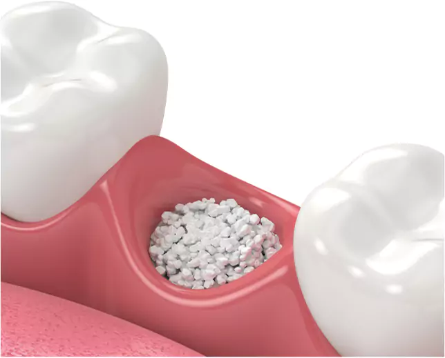 3D illustration of a dental bone graft placed in a missing tooth socket.