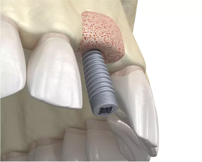 3D-rendered image of a dental implant placed with a bone graft in the upper jaw.