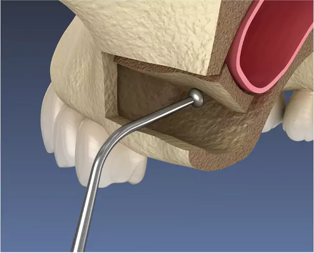 3D-rendered illustration of a sinus lift surgery showing bone augmentation in the upper jaw.