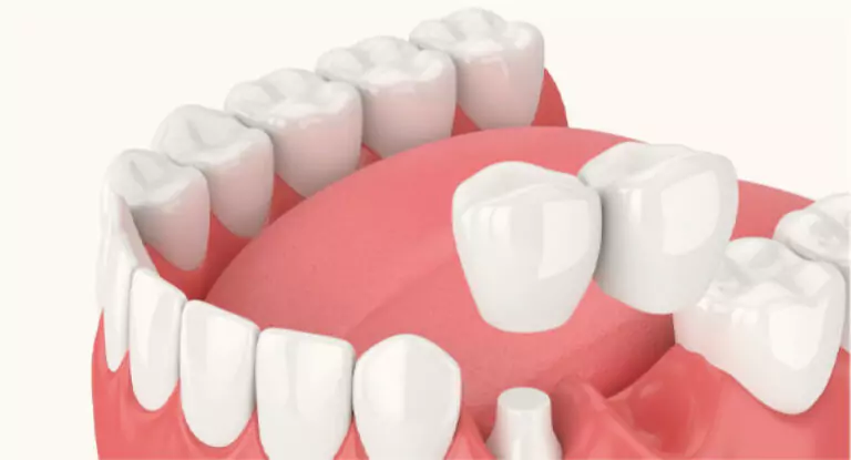 3D illustration of a cantilever dental bridge being placed over a prepared tooth.