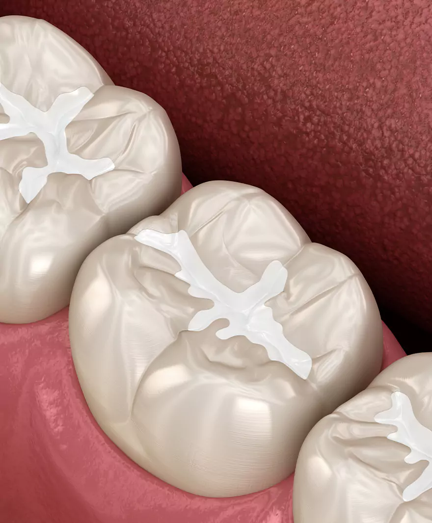 Illustration of molars with dental sealants applied to prevent cavities.