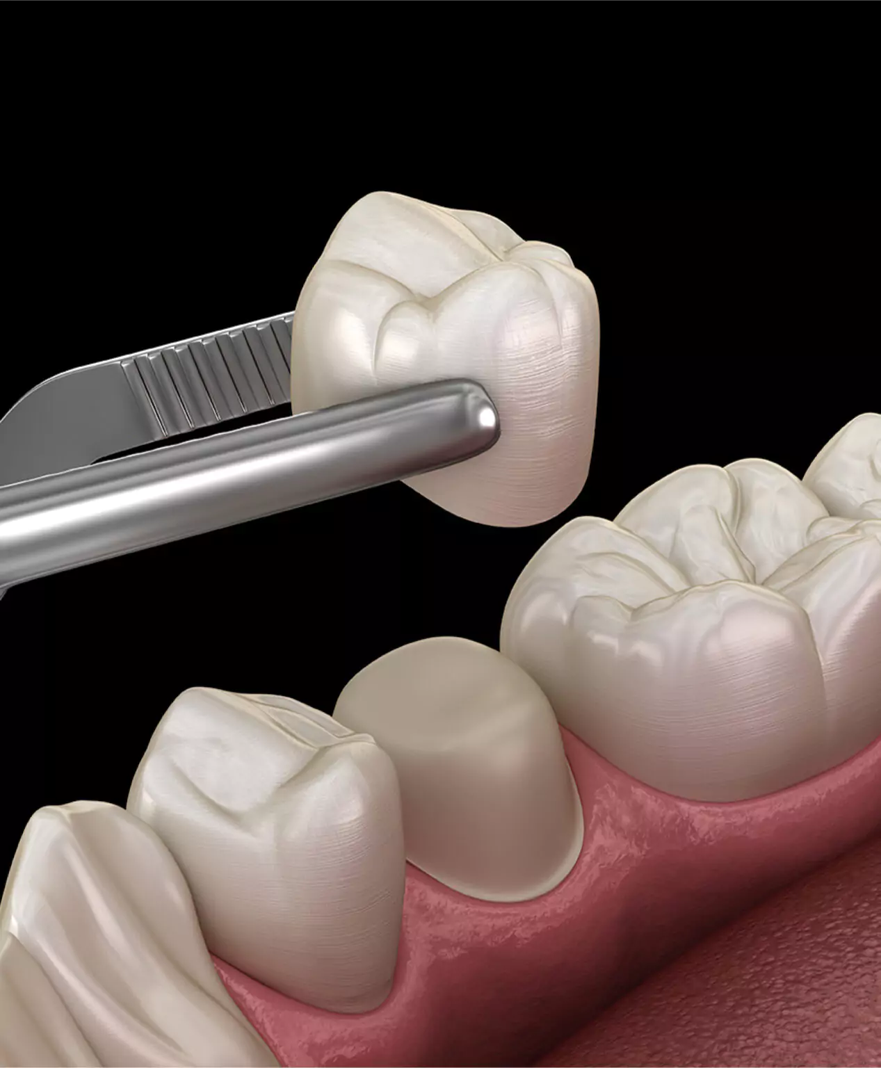 3D illustration of a dental crown being placed onto a prepared tooth.