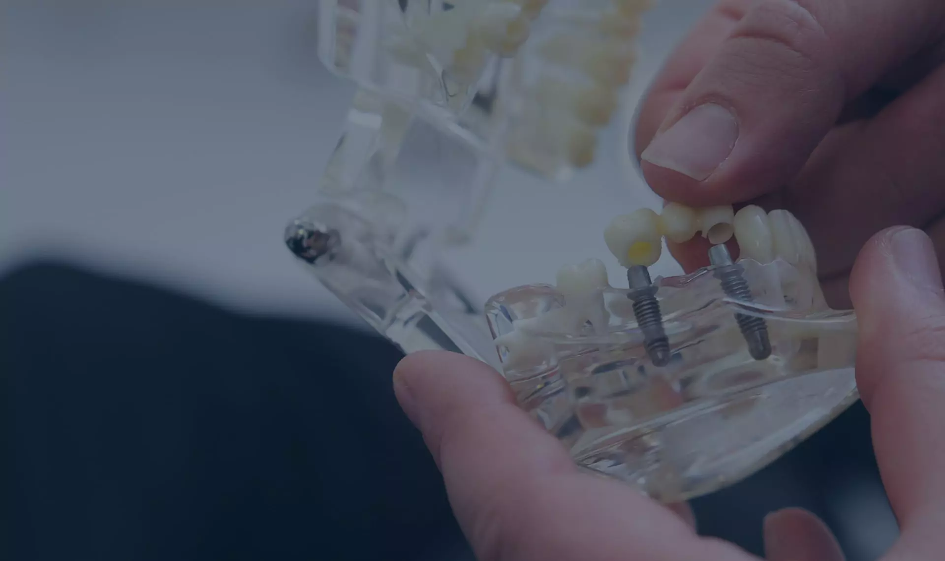 A close-up of hands holding a transparent dental model with implant-supported crowns, showcasing the structure of dental implants.
