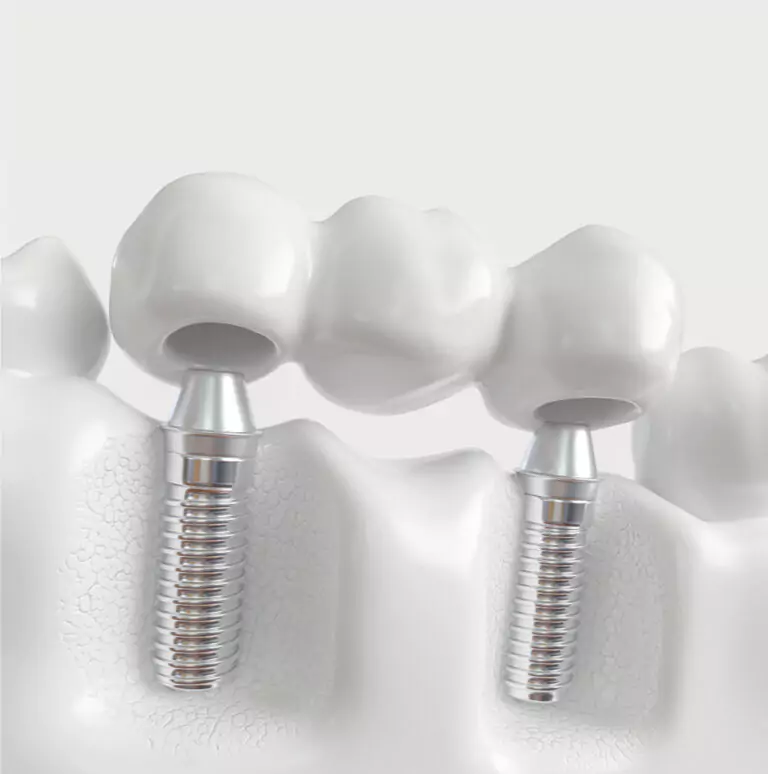 A 3D illustration of an implant-supported dental bridge showing titanium implants and artificial teeth.