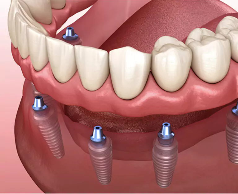 A 3D-rendered illustration showing an All-on-4 dental implant system with four implants supporting a full-arch prosthetic.