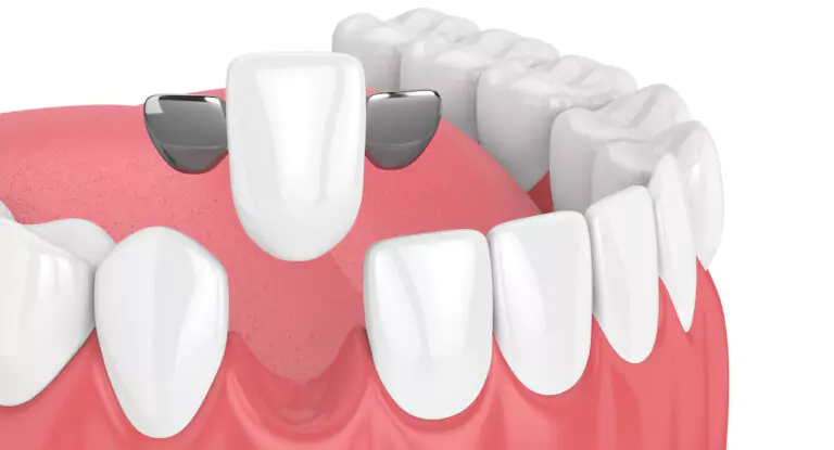 3D illustration of a Maryland dental bridge with metal wings attached to adjacent teeth.