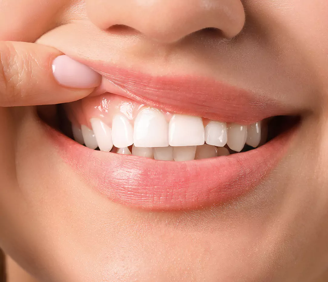A close-up of a smiling mouth with white teeth and healthy gums, with a finger slightly pulling the lip up.