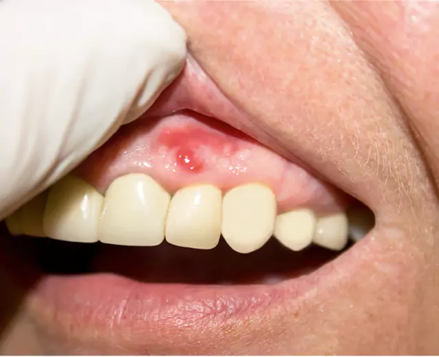 A close-up of a person's gums showing redness, swelling, and a visible abscess above the teeth.