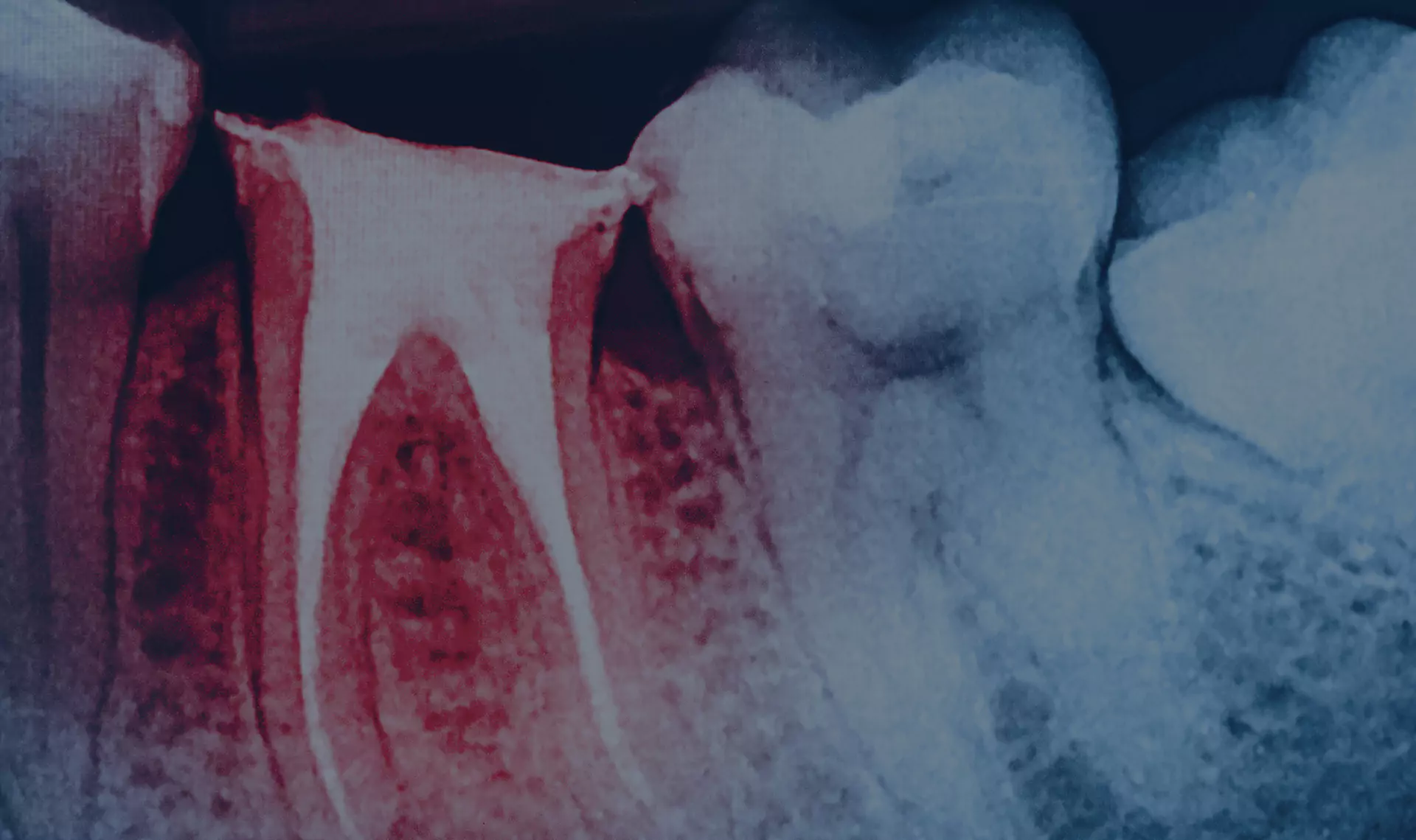 Dental X-ray highlighting an infected tooth with root damage, showing areas of decay and inflammation.