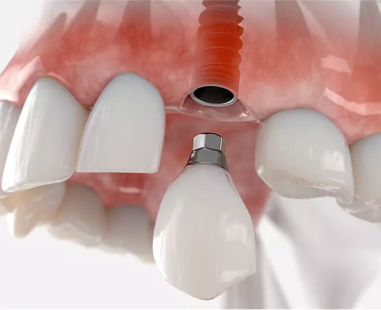 A 3D-rendered image showing the process of attaching a dental crown to an implant in the upper jaw.