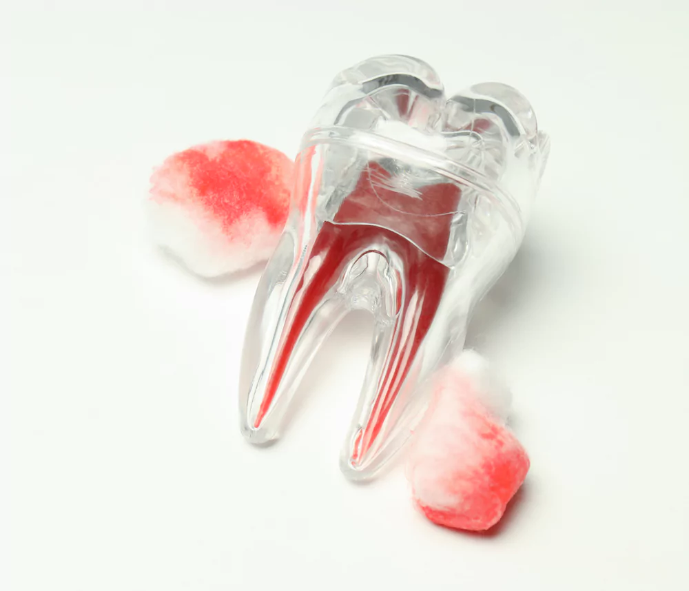 A transparent model of a tooth with red roots, symbolizing tooth extraction, alongside blood-stained cotton balls on a white background.