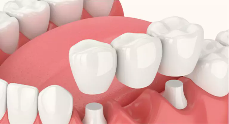 3D illustration of a traditional dental bridge being placed over prepared teeth.