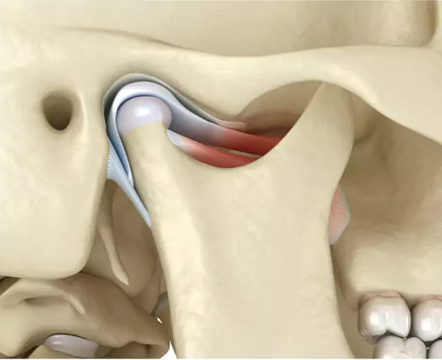 Detailed 3D illustration of the temporomandibular joint (TMJ), showing the joint structure, cartilage, and muscles involved in jaw movement.