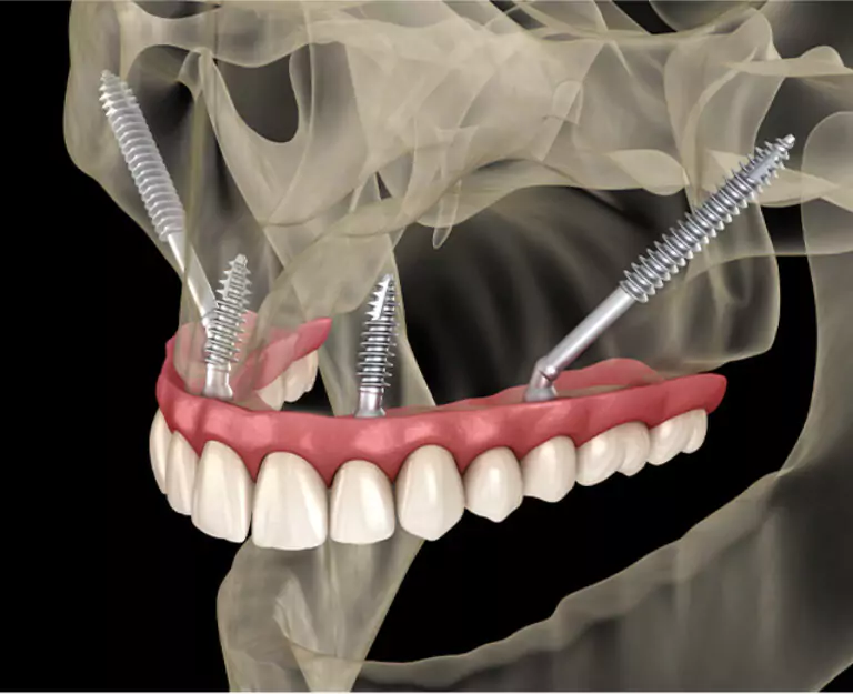 A 3D-rendered X-ray view of an All-on-4 dental implant system with four titanium implants supporting a full arch of upper teeth.