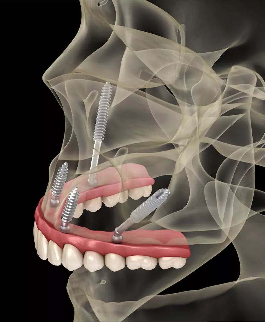 3D-rendered illustration of zygomatic dental implants anchored into the cheekbone for full-arch tooth restoration.