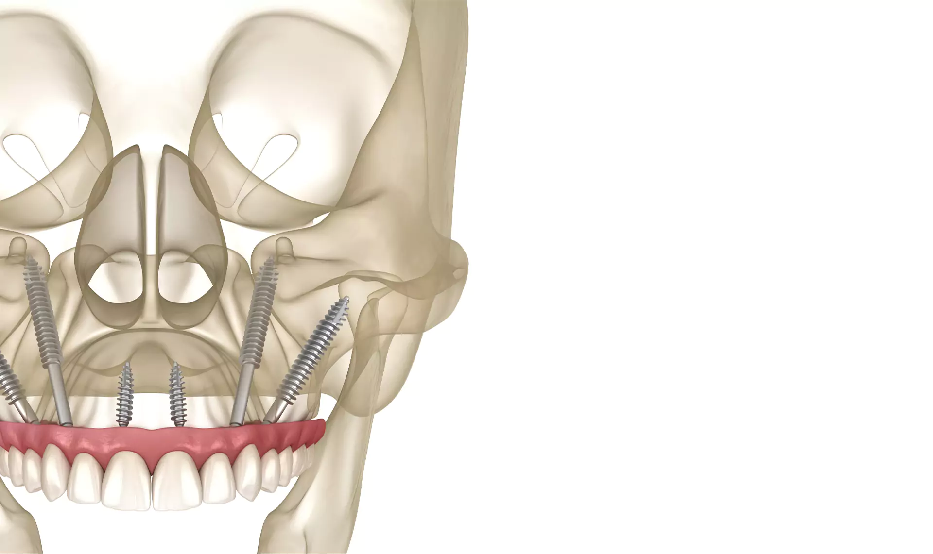 3D-rendered illustration of a full-arch dental implant system with zygomatic and standard implants anchored in the upper jaw.