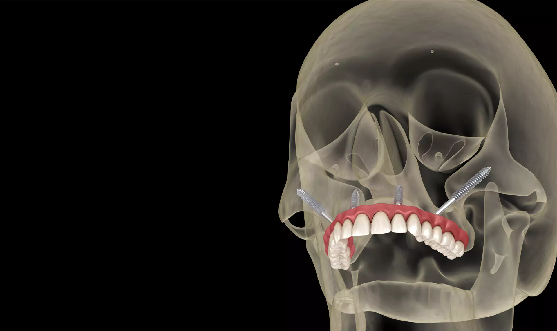 3D-rendered X-ray view of a skull with zygomatic and standard dental implants supporting a full upper arch prosthesis.